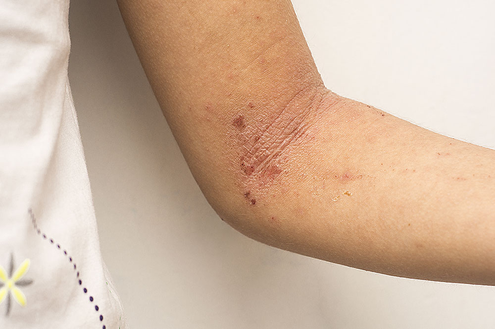 Atopic Dermatitis – Top 5 Aggravating Foods