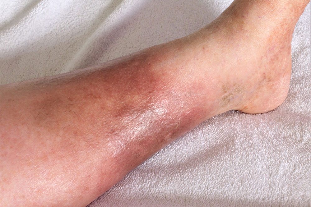 DVT – Risk Factors and Prevention