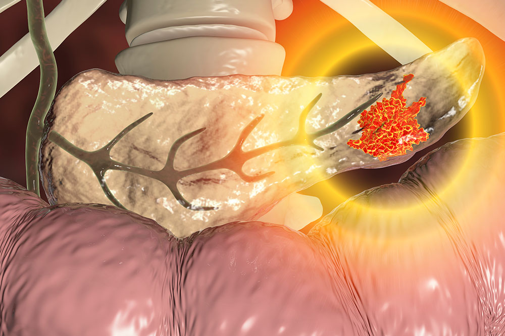 Pancreatic Cancer – Genetic and Hereditary Risk Factors