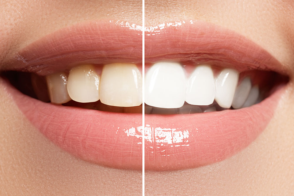 5 Best Natural Teeth-whitening Procedures