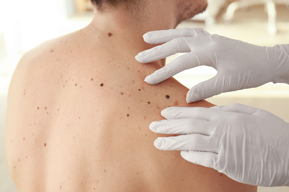 6 Melanoma Complications to Know