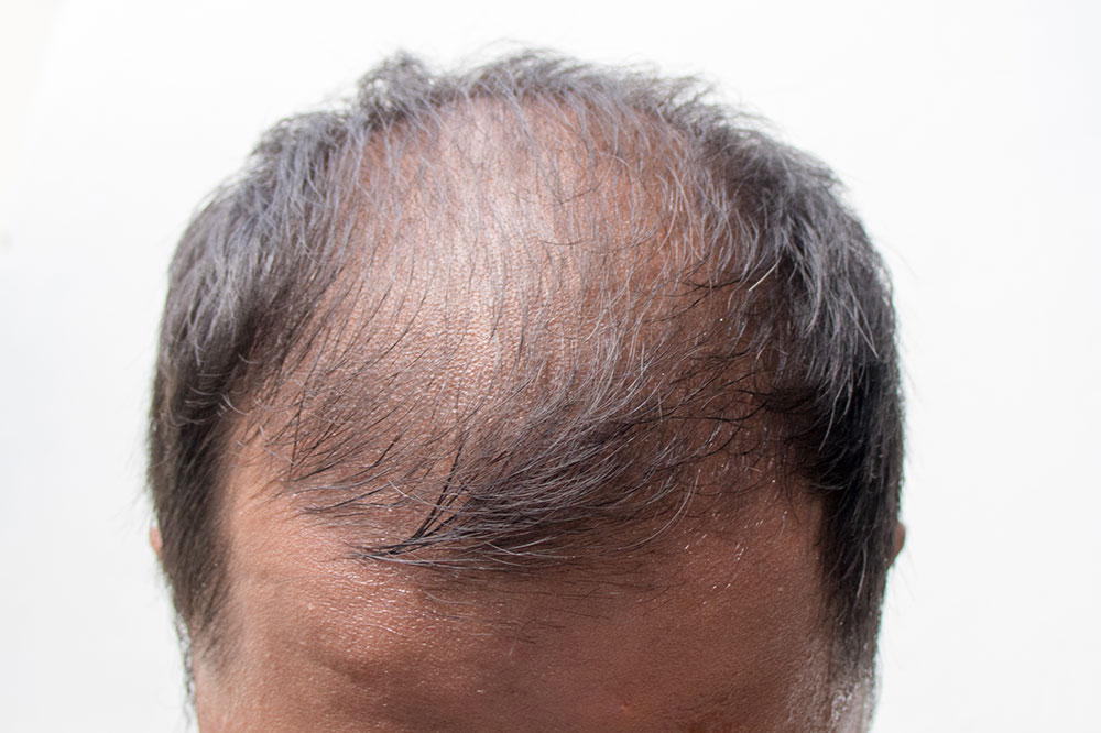 6 Ways to Beat Male Pattern Baldness