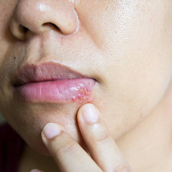7 Home Treatment Options for Cold Sores