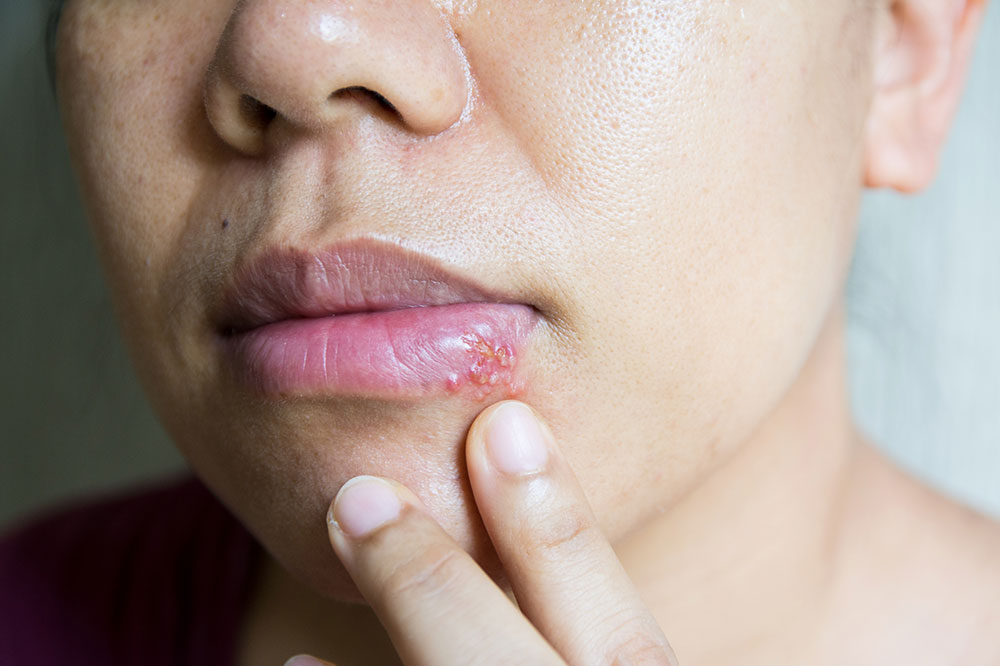 7 Home Treatment Options for Cold Sores